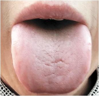 阴虚、阳虚傻傻分不清?张嘴伸舌一看便知