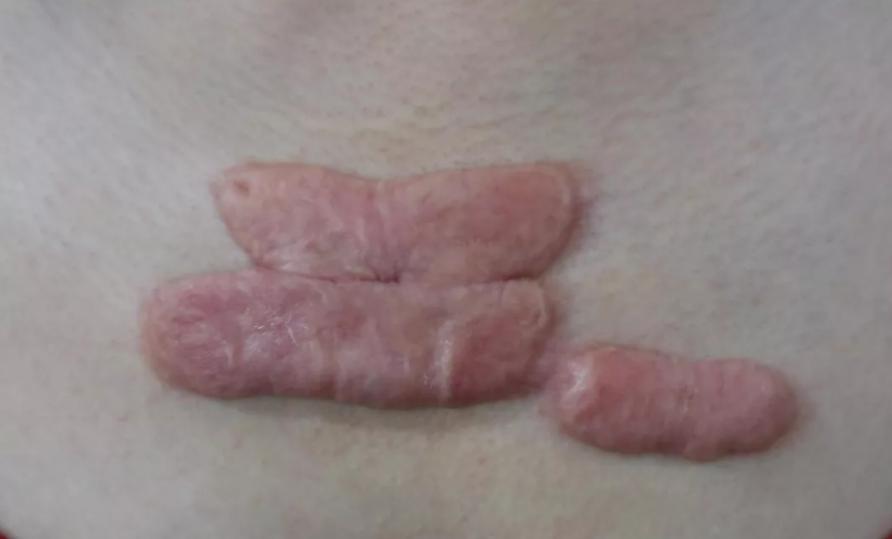 疤痕疙瘩不治疗要紧吗,疤痕疙瘩不治疗能治好吗