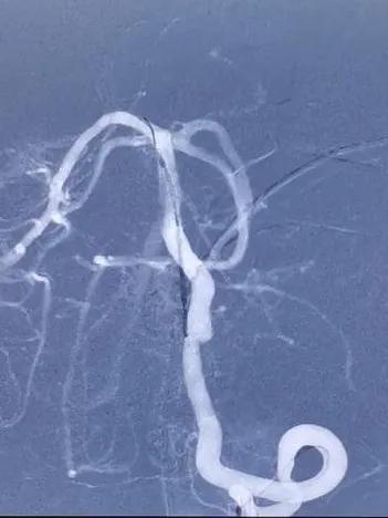 淄博市中心医院治疗动脉瘤,tubridge动脉瘤支架医保报销多少