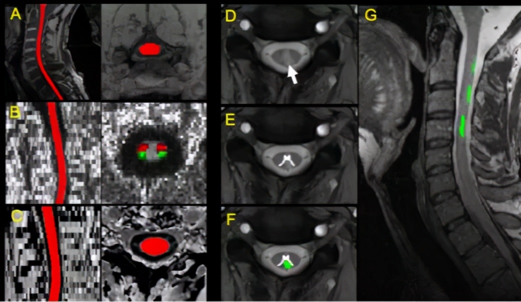 中枢神经系统脱髓鞘疾病影像学,中枢神经系统脱髓鞘疾病基因检测