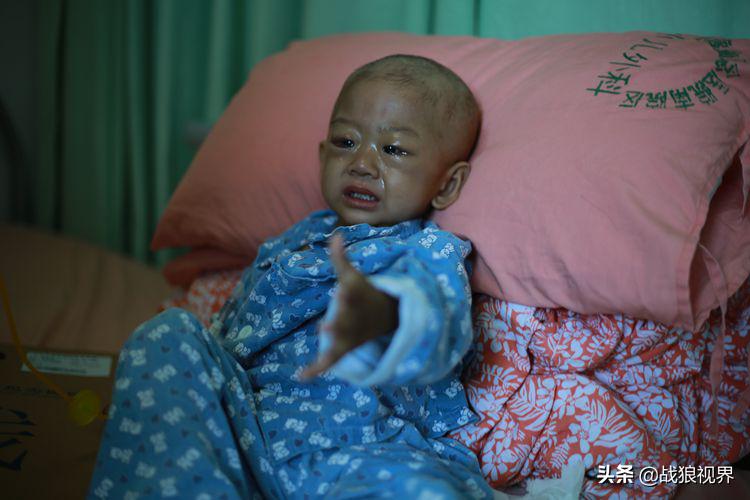 小孩摔一跤后引起眼袋淤青,2岁多男宝眼袋浮肿有点发紫