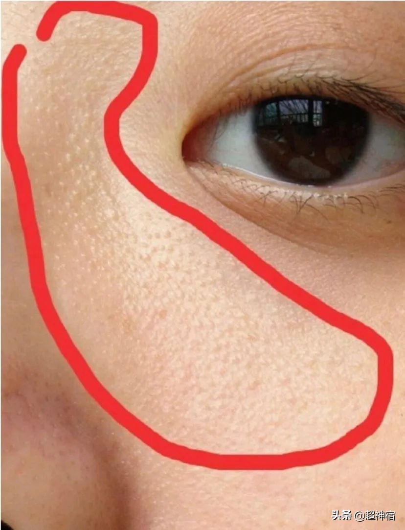 比痘痘更烦人的闭口来了,最有效的去闭口*法大**看过来