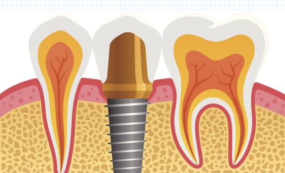 种植牙影响核磁共振和脑ct吗,种植牙影响核磁共振和ct吗