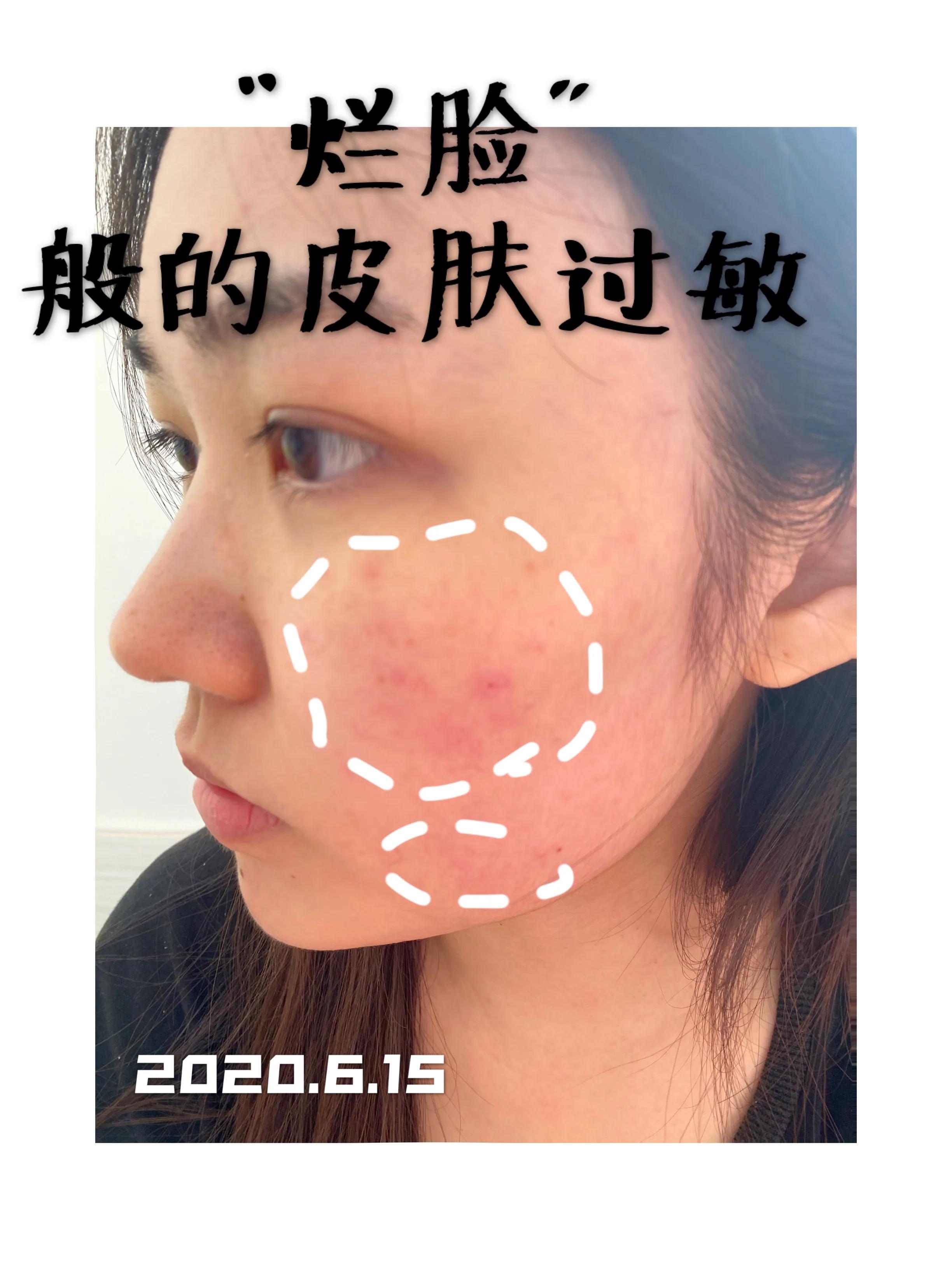 视黄醇过敏烂脸怎么治,烂脸过敏的自救方法