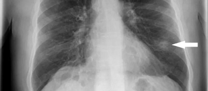 体检查出肺结节莫慌中医有妙招,体检查出肺结节别慌