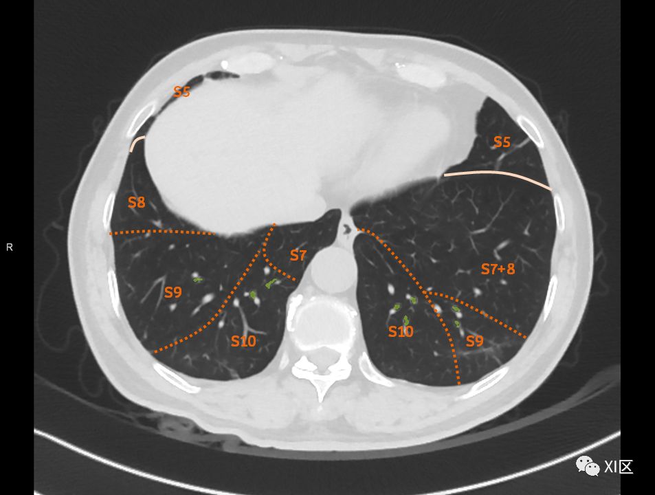 如此详细的肺部影像解剖，有点儿酷