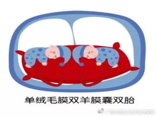 双胎妊娠分娩，顺产行不行？