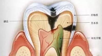 牙齿小洞不补下一句是什么,牙齿小洞不补大洞吃苦的意思