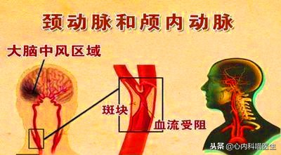 阿托伐他汀钙片降血脂降尿酸,阿托伐他汀和瑞舒伐他汀哪个升尿酸