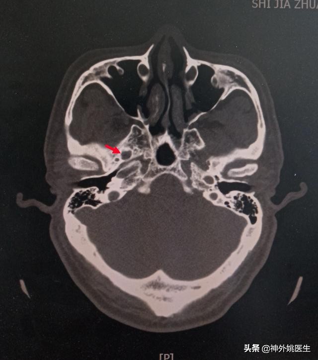 三叉神经痛微创治疗方法,超微创定向修复三叉神经