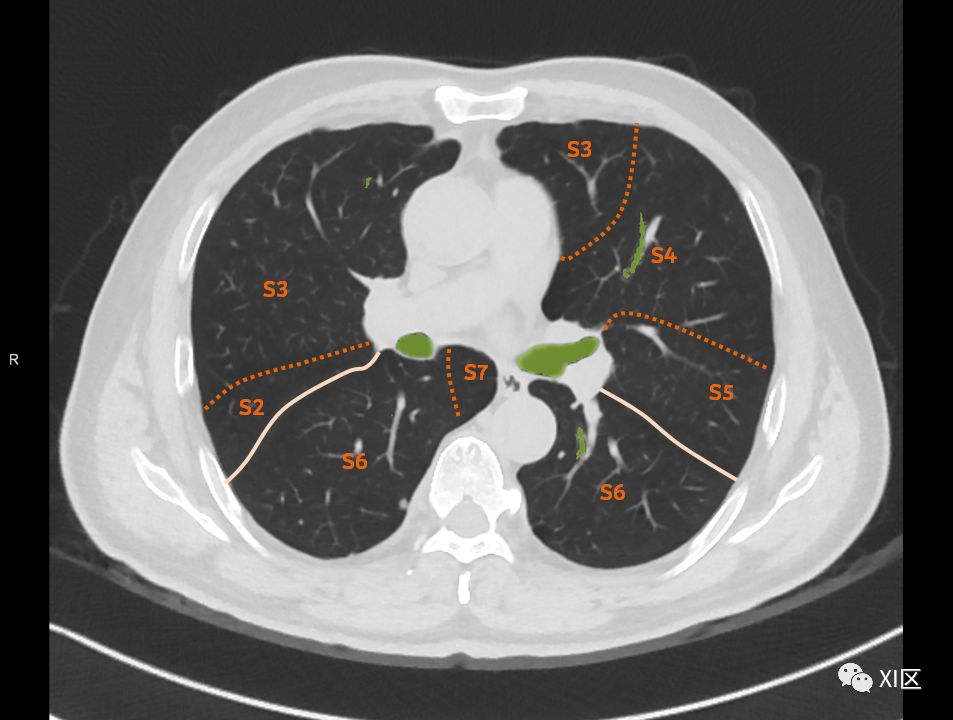 如此详细的肺部影像解剖，有点儿酷
