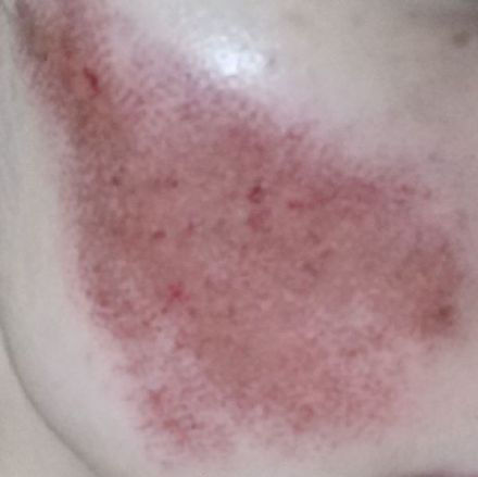 点阵激光能修复到什么程度,点阵激光凹陷疤痕能修复多少