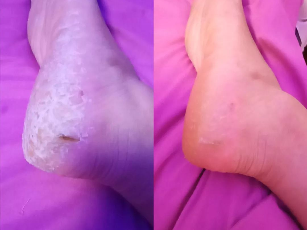 冬天脚后跟干裂用什么润脚霜,润足脚后跟干裂修复霜