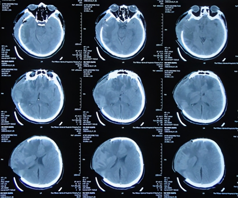 脑外伤开颅手术后脑积水,脑外伤手术后脑脊液鼻漏怎么治疗