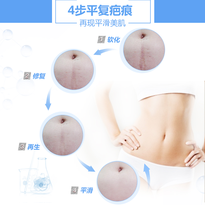 剖腹产疤痕怎么快速消除小妙招,一白遮百丑的调理方法
