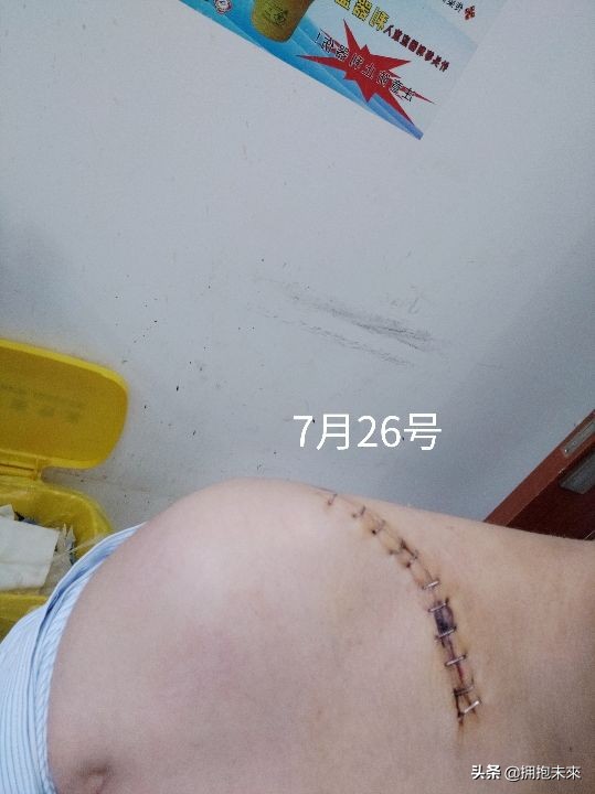 肾移植伤口可以自己换药吗,锁骨骨折取钢板后几天换药一次