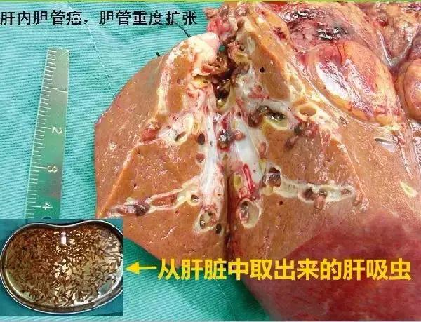 深圳女子零食里吃出铁钉,女子体内取出活虫只因吃这道菜