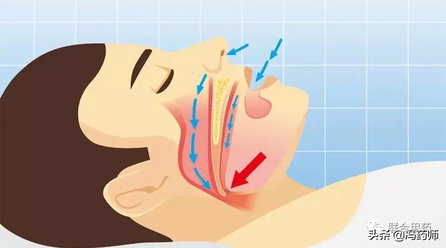 打鼾的药物,打鼾的原因及中药治疗方法