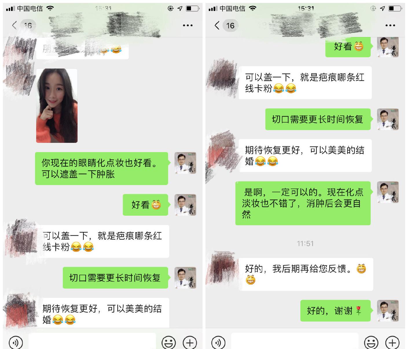 双眼皮整容失败眼皮跳动,双眼皮整形失败修复还花钱吗