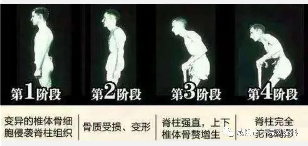 强直性脊柱炎号称不死的癌症,咸阳市强直性脊柱炎定点医院