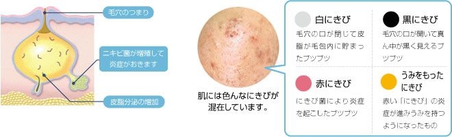 暗疮最好的消除方法 (暗疮印最佳治疗方法)