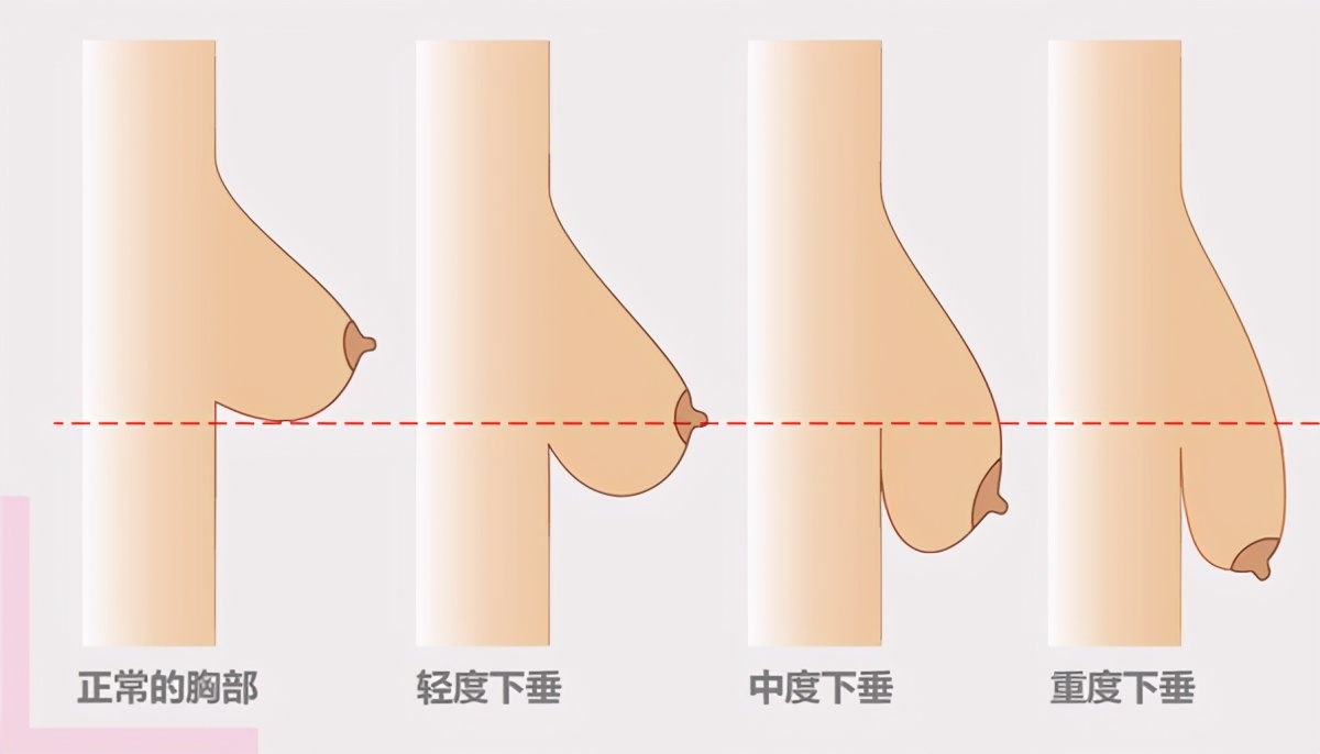 「医美科普」乳房下垂的原因是什么？严重怎么办？