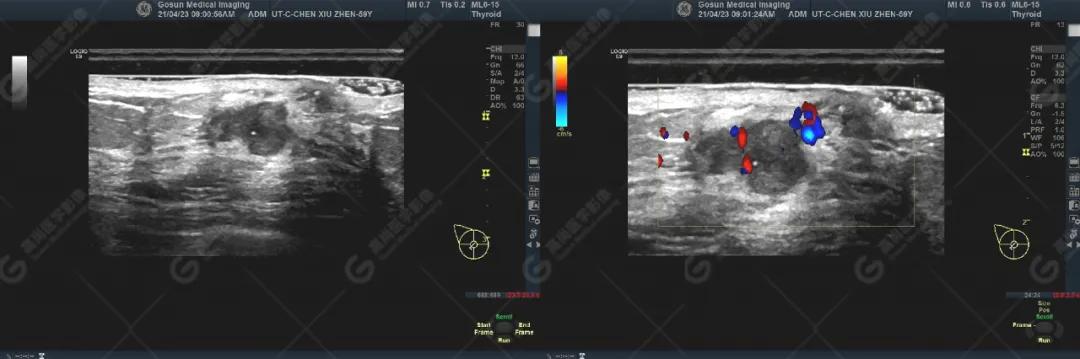 乳腺癌肿瘤科普,乳腺癌结节科普