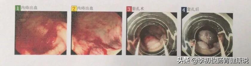 一次无痛胃肠镜一共需要多久,一次做完胃肠镜