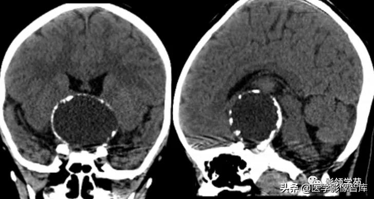 鞍区肿瘤做什么检查得出来,鞍区肿瘤的影像学鉴别