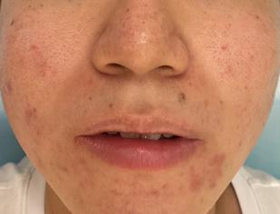 青春期月经逐渐规律的过程中长痘,青春期的痘痘来月经后会消失吗