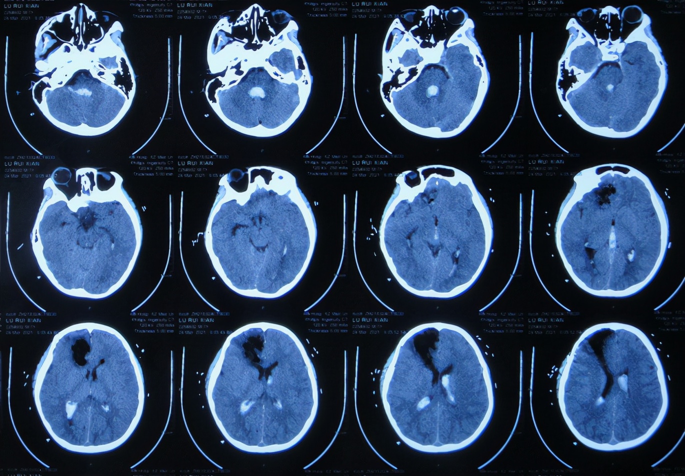 儿童脑出血昏迷三天后恢复正常了,脑出血后脑积水多久会出现症状