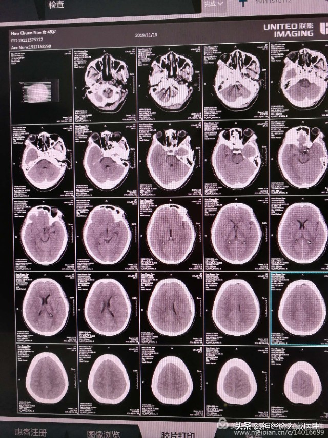 神经外科手术动脉瘤,湖南省人民医院脑动脉瘤介入治疗