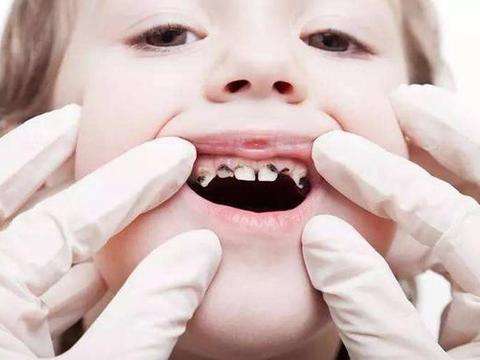 4岁孩子长龋齿，不仅是刷牙的问题，牙医：可能跟这几个习惯有关