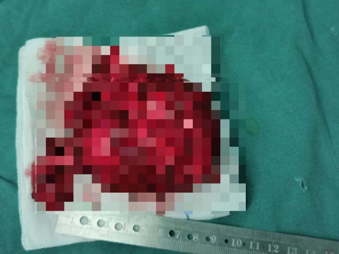 一女孩臀部长了大肿瘤，我院多科室协作切除肿瘤