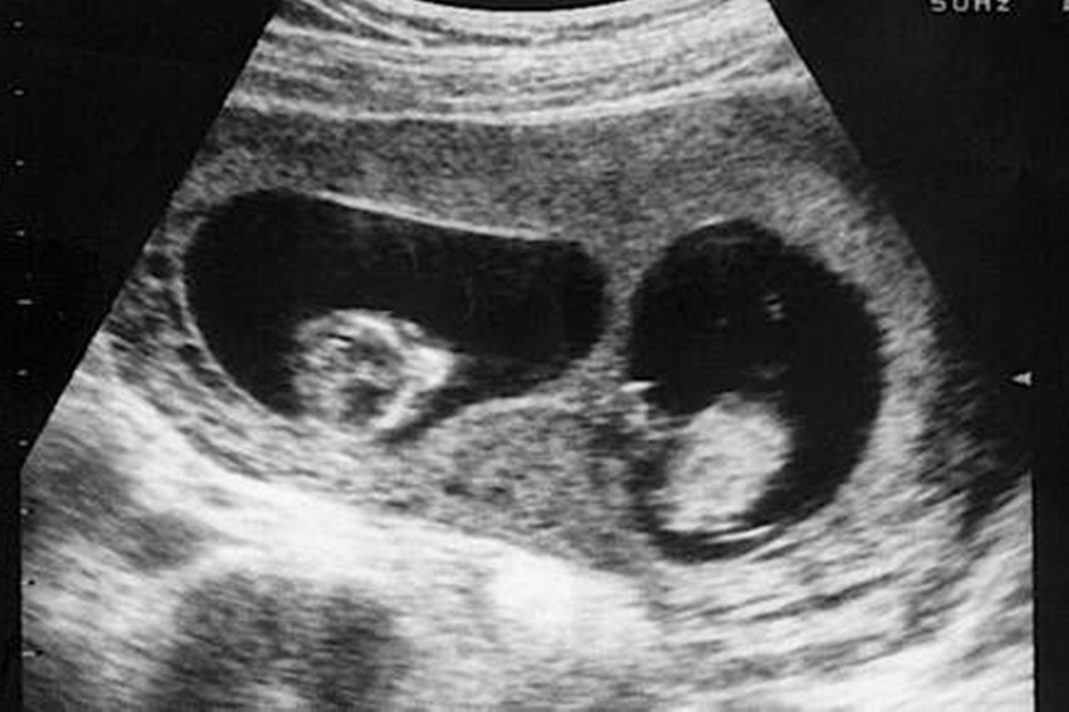 双胞胎妹妹身上有胎记,龙凤胎姐姐被抱养