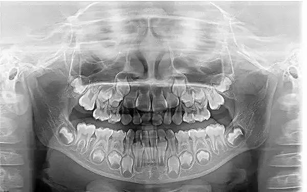 3岁宝宝牙齿需要做什么,三岁宝宝治疗牙齿过程