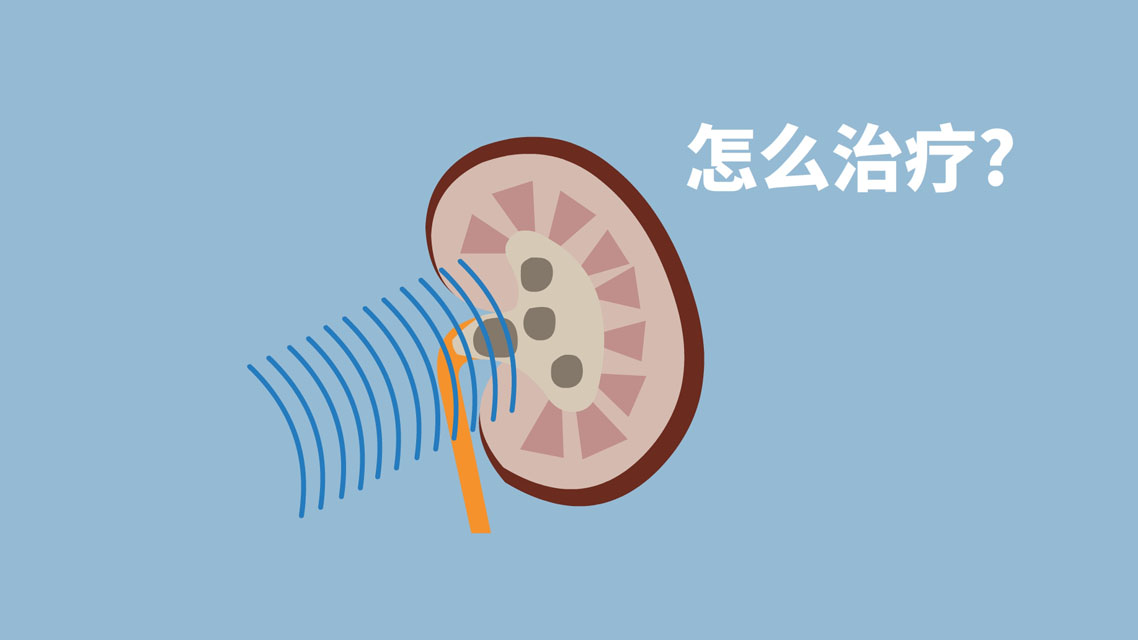 哪种结石可以做体外冲击波,科普体外冲击波是如何碎结石的