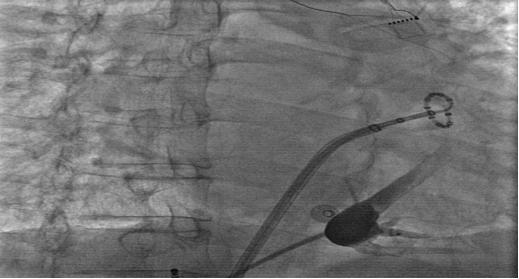 marshall房颤消融术,marshall房颤
