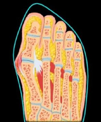 老年人拇外翻怎么回事,老人拇外翻最近痛是什么原因呢