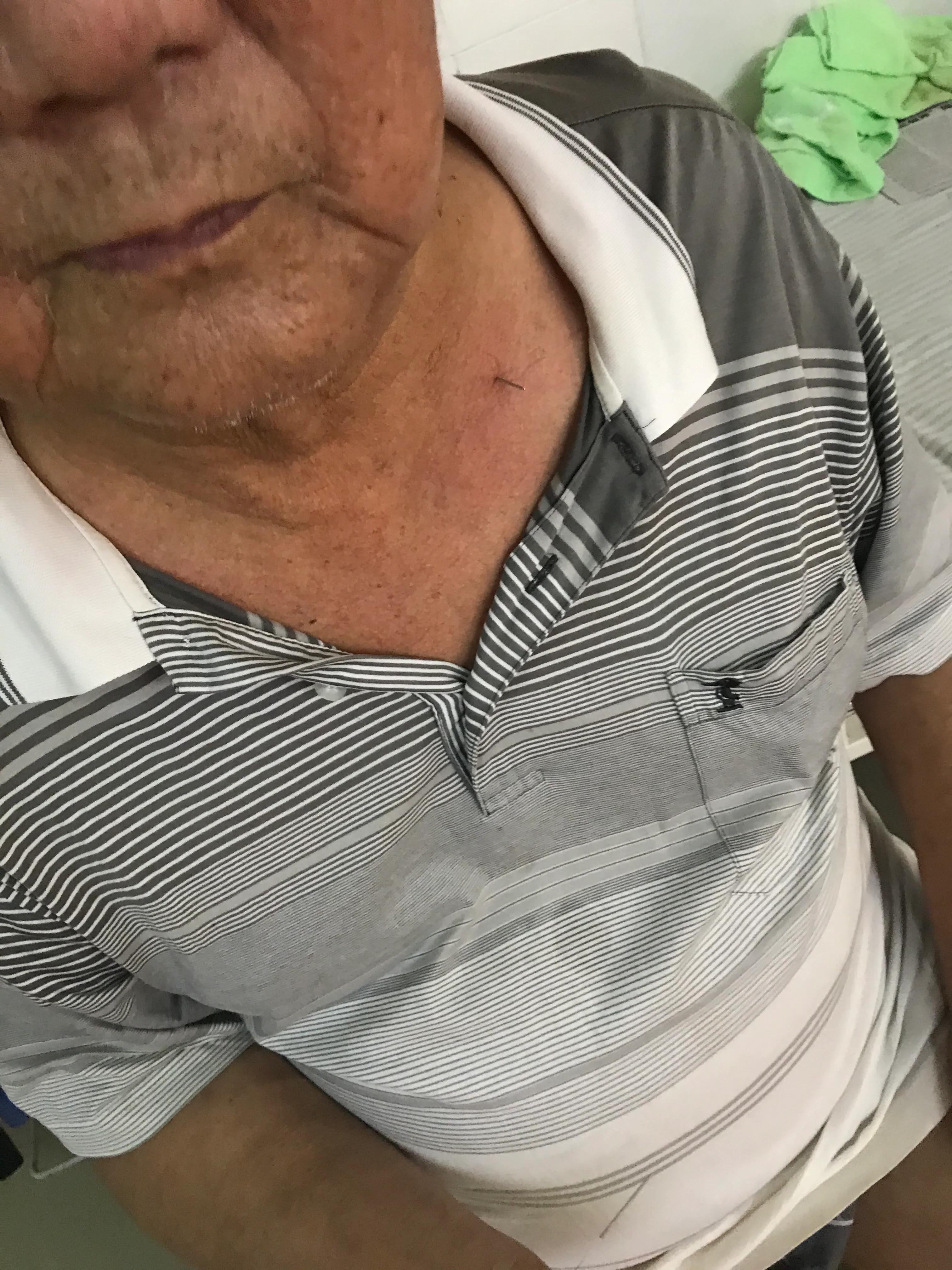 董氏奇穴针灸治疗足跟痛,董氏针刺治足跟痛视频