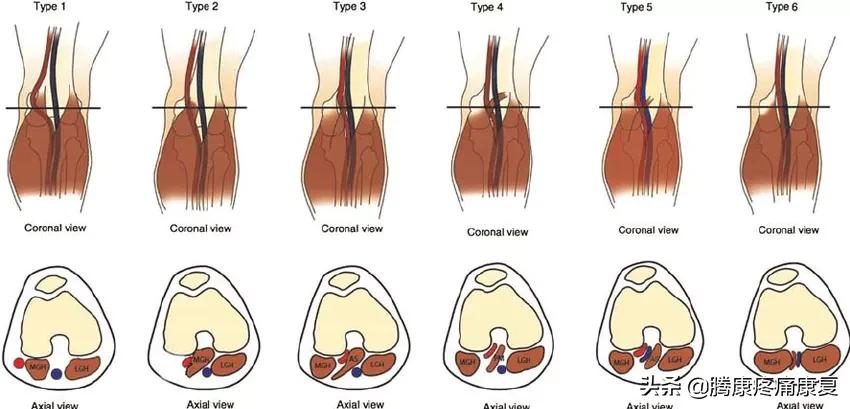 小腿膝关节疼痛是什么原因,小腿窝疼痛是什么原因造成的