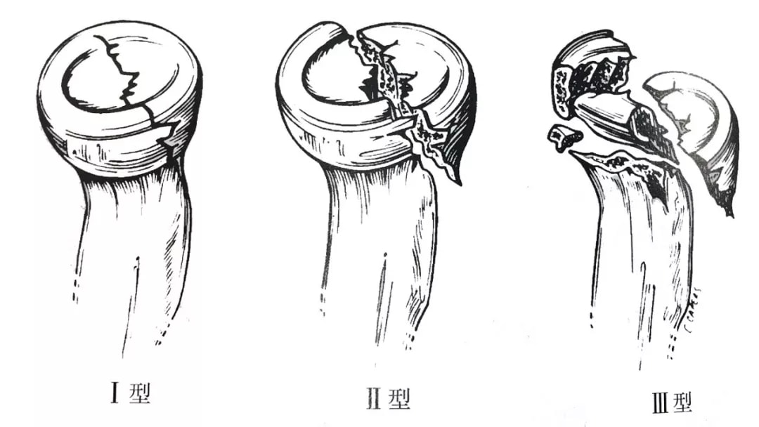 小孩手被提拉后动不了，怎么去预防呢？听医生说