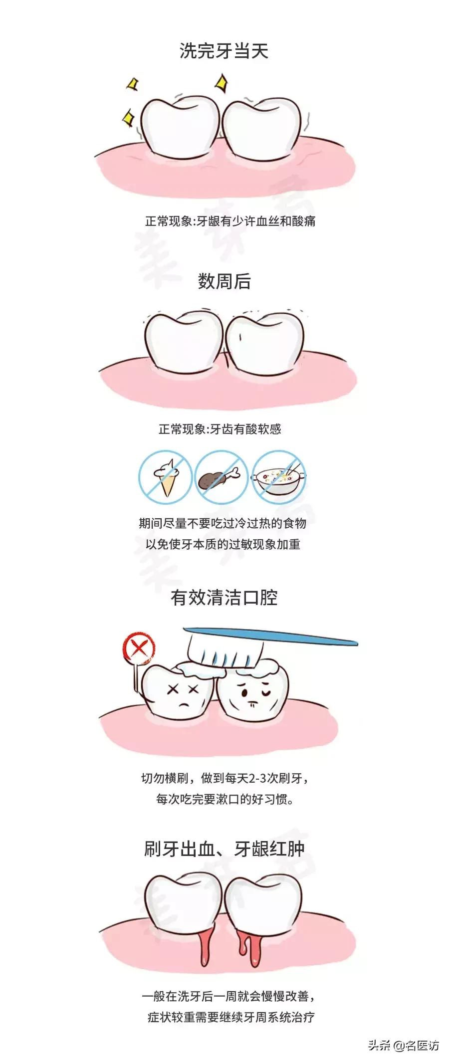 洗牙攻略,洗牙全攻略