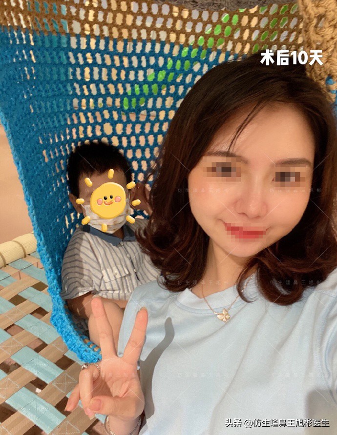 鼻头肥大矫正加鼻翼缩窄案例,鼻头缩小术后