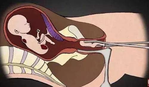 围术用药丨人工流产手术的麻醉进展