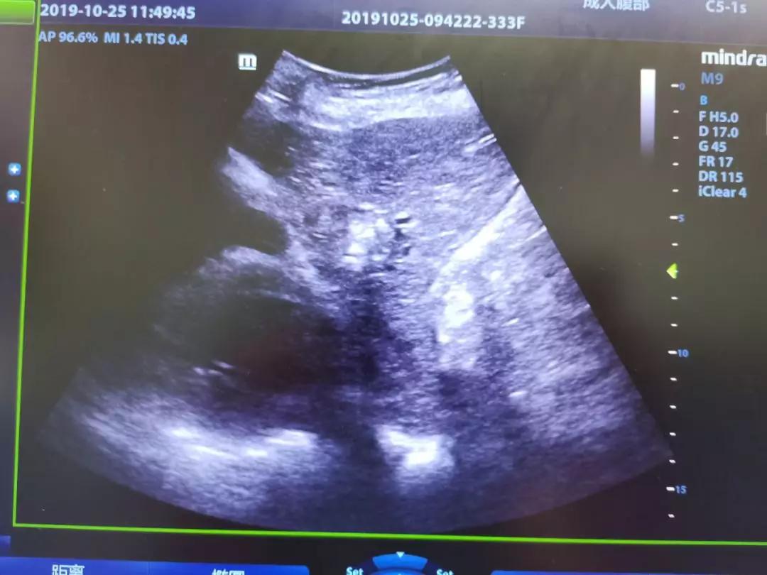 陕西中医药大学超声医学,射频消融术对肝癌治疗的疗效