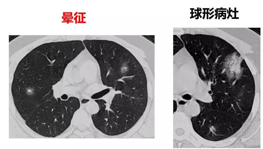 新型冠状病毒肺炎相关知识答疑,新型冠状病毒肺炎必须知道什么