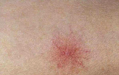 女性肚皮上长痣是肝有问题么,樱桃痣是肝不好吗