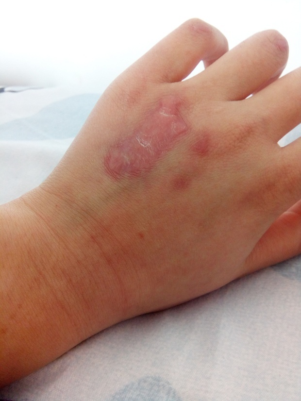 疤痕疙瘩如何祛红,去除疤痕红印的方法