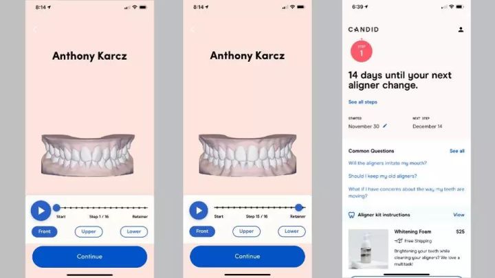 矫正牙齿3d打印隐形牙套 (安齿3d打印种植牙)
